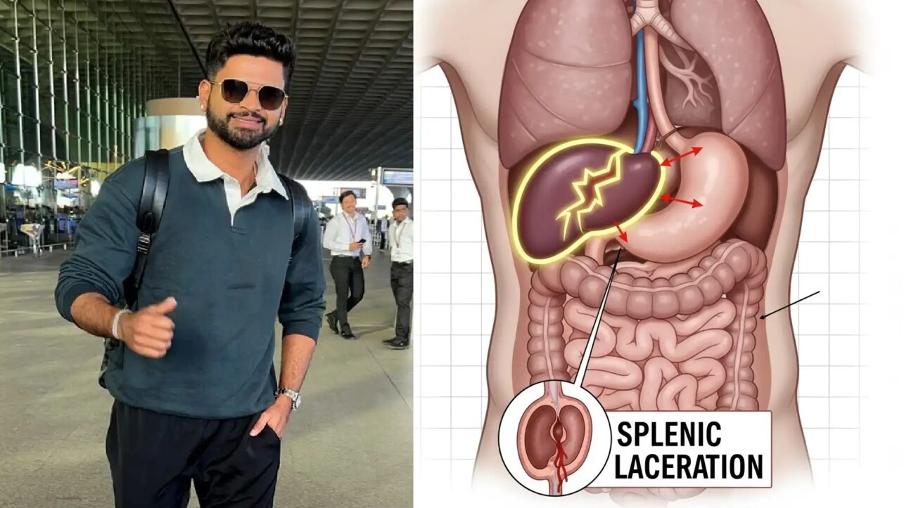 Indian Cricketer Shreyas Iyer Hospitalized in Sydney ICU After Splenic Injury during Match 3 Indian Cricketer Shreyas Iyer Hospitalized in Sydney ICU After Splenic Injury during Match